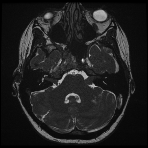 Neurofibromatosis type 2 - bilateral acoustic neuromata (Radiopaedia 40060-42566 Axial FIESTA 39).png