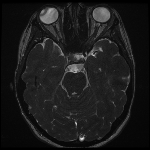 File:Neurofibromatosis type 2 - bilateral acoustic neuromata (Radiopaedia 40060-42566 Axial FIESTA 71).png