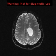 File:Neuroglial cyst (Radiopaedia 10713-11184 Axial DWI 8).jpg