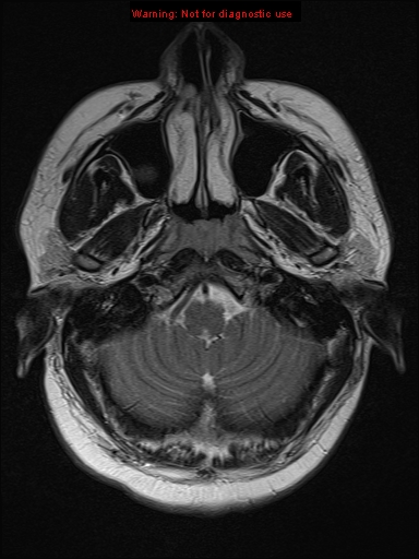 File:Neuroglial cyst (Radiopaedia 10713-11184 Axial T2 20).jpg
