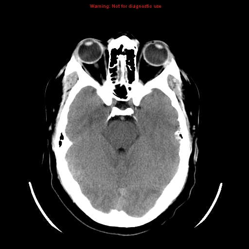File:Neuroglial cyst (Radiopaedia 10713-11185 Axial non-contrast 22).jpg