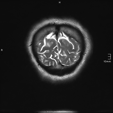 File:Neurotoxoplasmosis - concentric target sign (Radiopaedia 70644-80784 Coronal T2 7).jpg