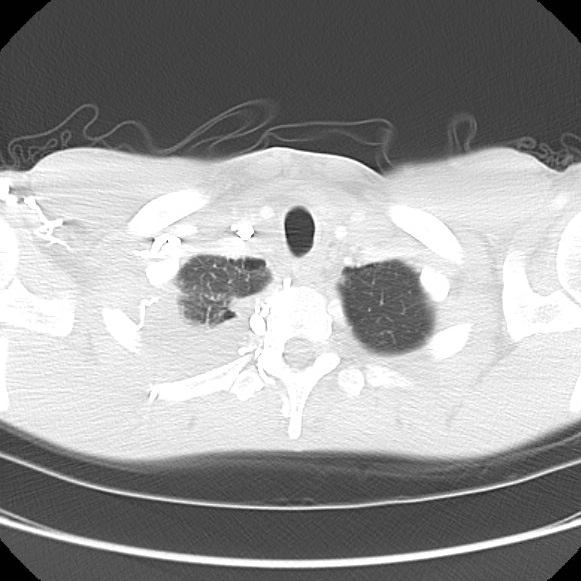 File:Non-Hodgkin lymphoma involving lung (Radiopaedia 29094-29470 Axial lung window 11).jpg