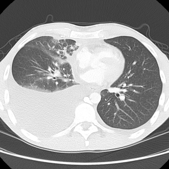 File:Non-Hodgkin lymphoma involving lung (Radiopaedia 29094-29470 Axial lung window 41).jpg