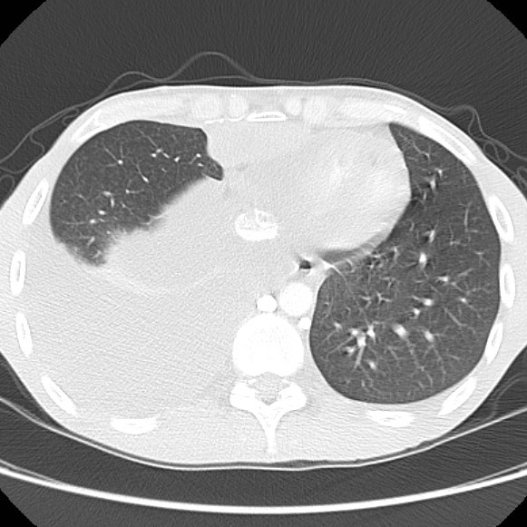 File:Non-Hodgkin lymphoma involving lung (Radiopaedia 29094-29470 Axial lung window 52).jpg