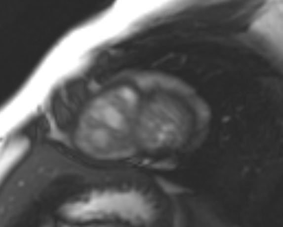 File:Non-compaction of the left ventricle (Radiopaedia 69436-79314 Short axis cine 42).jpg