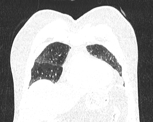 Non-specific interstitial pneumonia (NSIP) (Radiopaedia 68599-78228 Coronal lung window 15).jpg