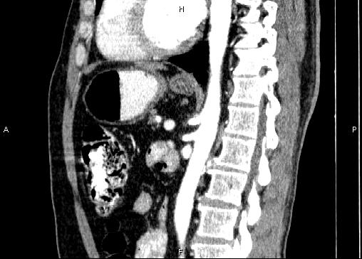 Non-syndromic pancreatic endocrine tumor (Radiopaedia 86958-103178 E 59).jpg