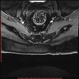 Non Hodgkin's lymphoma with metastasis to spine (Radiopaedia 54844-61103 Axial T1 C+ fat sat 50).jpg