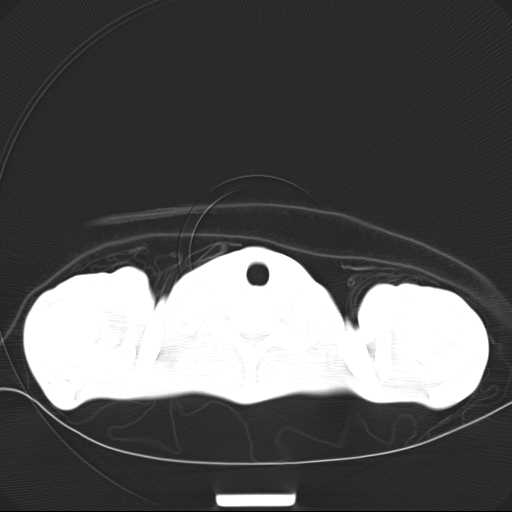 File:Non hodgkin lymphoma of the mediastinum (Radiopaedia 20814-20729 Axial lung window 1).jpg