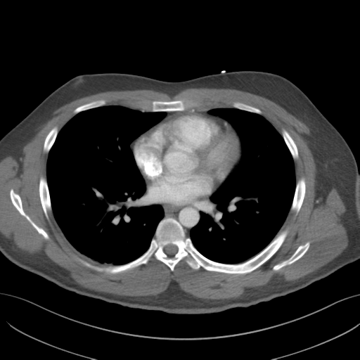 File:Normal CTA thorax (non ECG gated) (Radiopaedia 41750-44704 A 54).png