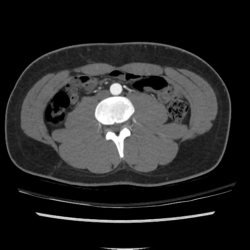 File:Normal CT angiogram of pelvis (Radiopaedia 45390-49430 A 10).jpg
