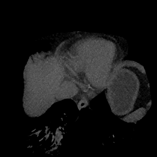 File:Normal CT intravenous cholangiogram (Radiopaedia 38199-40208 Axial IVC (MIP) 89).png