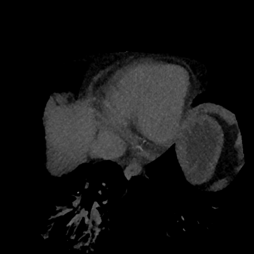 File:Normal CT intravenous cholangiogram (Radiopaedia 38199-40208 Axial IVC (MIP) 91).png