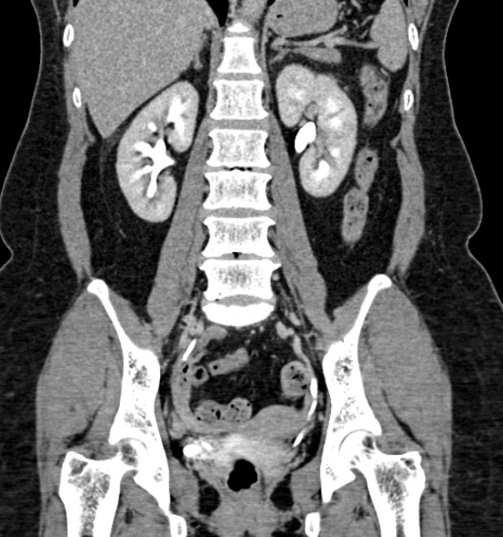 Normal CT intravenous urogram (Radiopaedia 39444-41759 A 296).jpg
