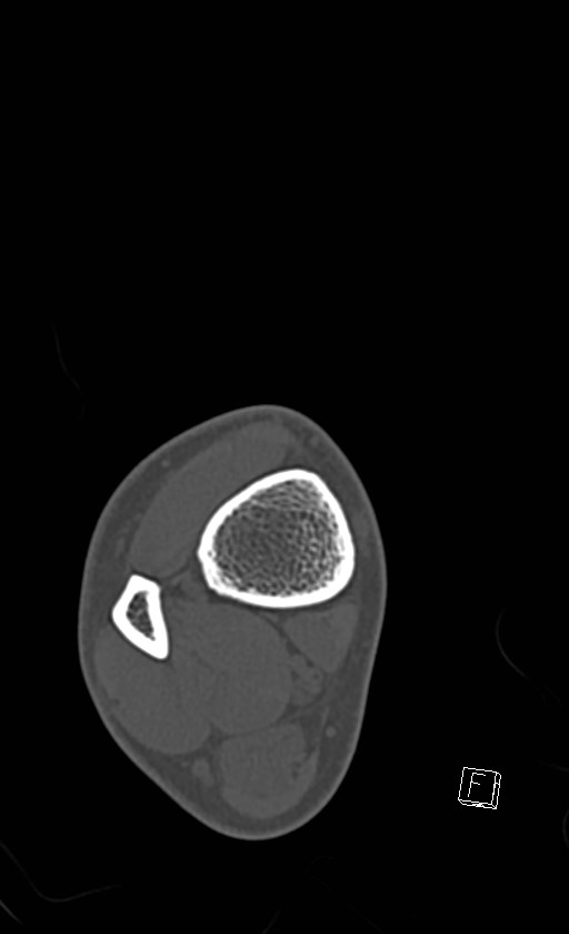 Normal CT of the ankle (Radiopaedia 47111-51658 Axial bone window 11).jpg