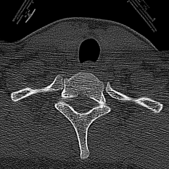 Normal CT of the cervical spine (Radiopaedia 53322-59305 Axial bone window 233).jpg