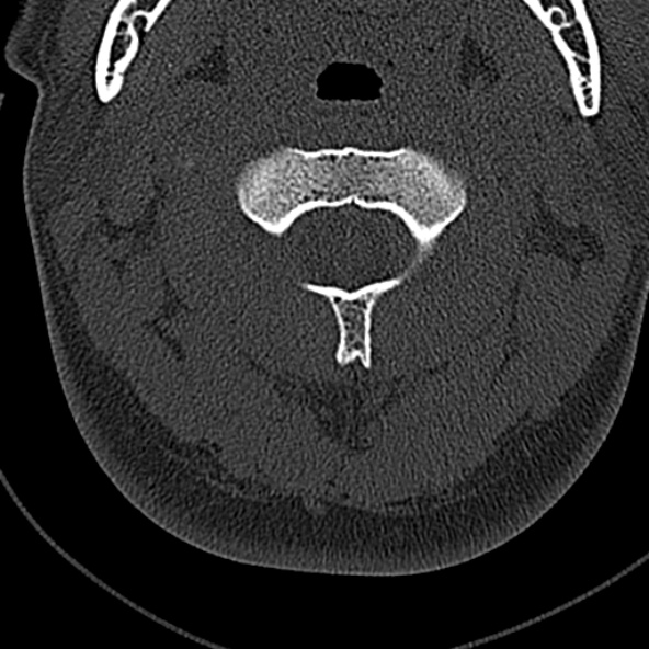Normal CT of the cervical spine (Radiopaedia 53322-59305 Axial bone window 76).jpg