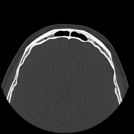 Normal CT paranasal sinuses (Radiopaedia 42286-45390 Axial bone window 17).jpg