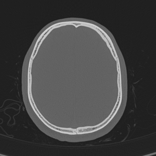Normal CT skull (Radiopaedia 40798-43459 A 118).png