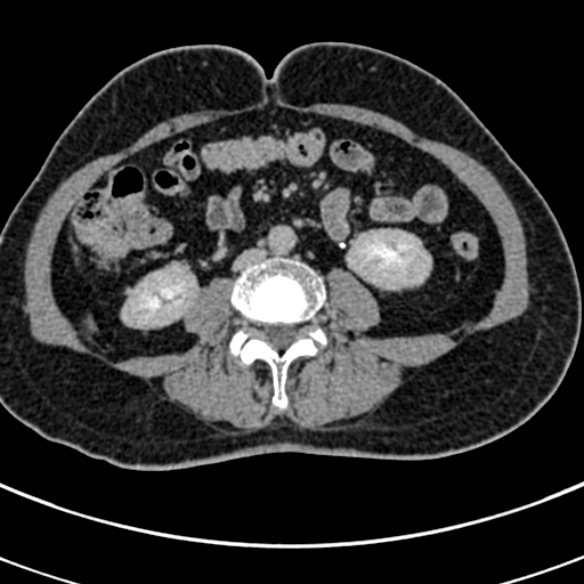 File:Normal CT split bolus study of the renal tract (Radiopaedia 48631-53634 Axial split bolus 142).jpg
