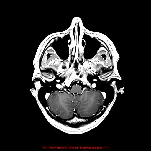 Normal adult brain MRI (non-enhanced and contrast-enhanced) (Radiopaedia 75262-86379 Axial T1 C+ 59).jpg