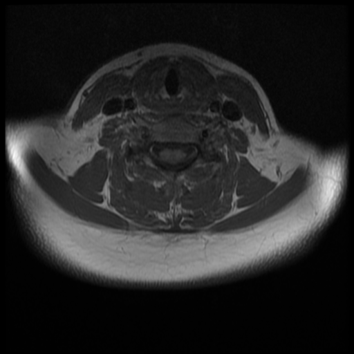File:Normal cervical and thoracic spine MRI (Radiopaedia 35630-37156 Axial T1 15).png