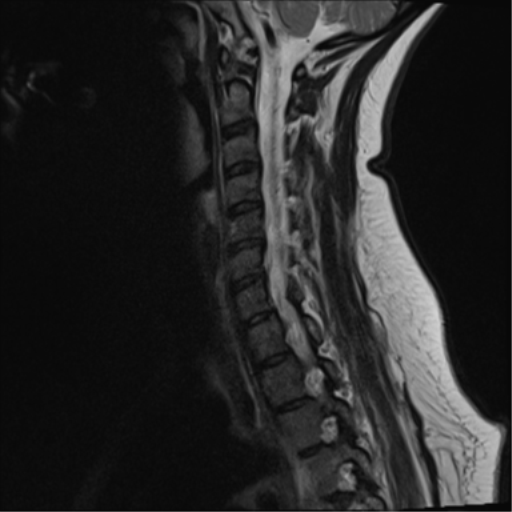 File:Normal cervical spine MRI (including Dixon) (Radiopaedia 42762-45925 Dixon- in-phase 6).png