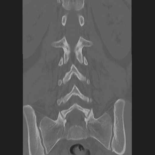 File:Normal lumbar spine CT (Radiopaedia 46533-50986 Axial bone window 1).png