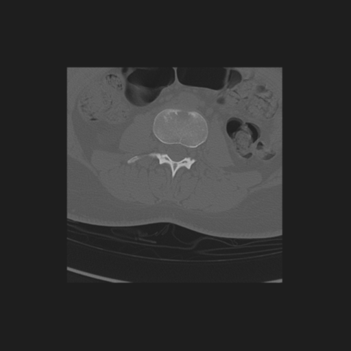 File:Normal lumbosacral CT (Radiopaedia 37923-39867 Sagittal bone window 1).png