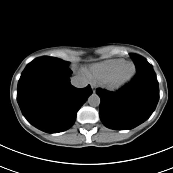 File:Normal multiphase CT liver (Radiopaedia 38026-39996 Axial non-contrast 1).jpg