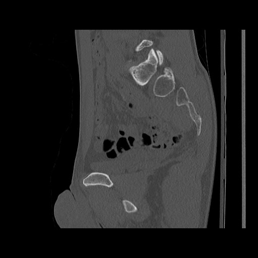 Normal pelvis (Radiopaedia 51473-57238 Sagittal bone window 63).jpg