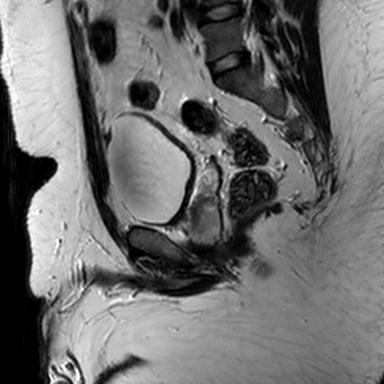 File:Normal prostate (MRI) (Radiopaedia 29986-30535 Sagittal T2 14).jpg