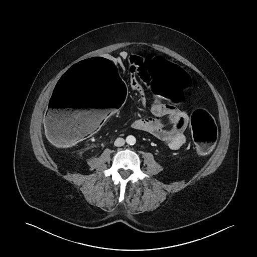 Obstructing sigmoid adenocarcinoma (Radiopaedia 58465-65619 A 99).jpg