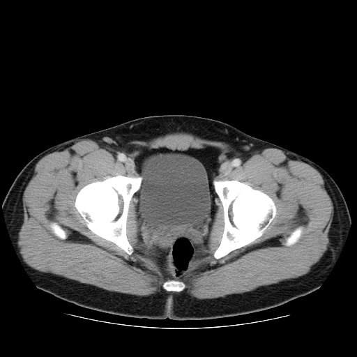 File:Obstructing ureteric calculus (Radiopaedia 18615-18514 B 53).jpg
