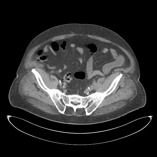 File:Obstructive pyelonephritis (Radiopaedia 46411-50844 Axial non-contrast 61).png
