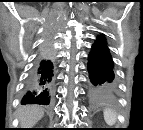 File:Obstructive superior vena cava tumor thrombus (Radiopaedia 28046-28306 B 42).jpg