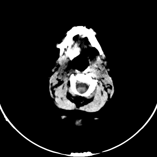 Occipital encephalocele (Radiopaedia 87339-103636 Axial non-contrast 5).jpg