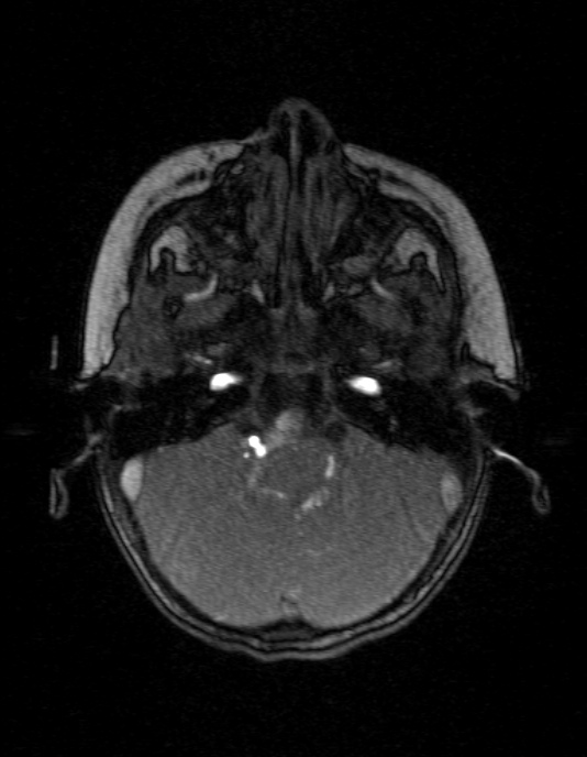 Occipital horn syndrome (Radiopaedia 14255-14129 MRA 29).jpg
