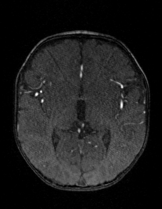 Occipital horn syndrome (Radiopaedia 14255-14129 MRA 83).jpg