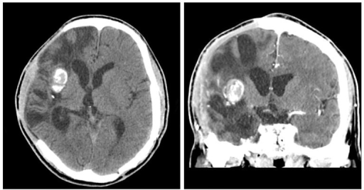CT scans show calcified brain abscess.