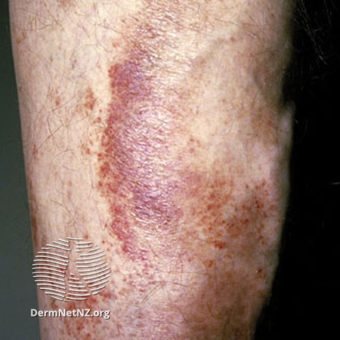 File:Venous stasis (DermNet NZ vascular-s-purpura3).jpg