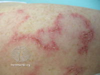 File:(DermNet NZ immune-subacute-lupus-03-s).jpg
