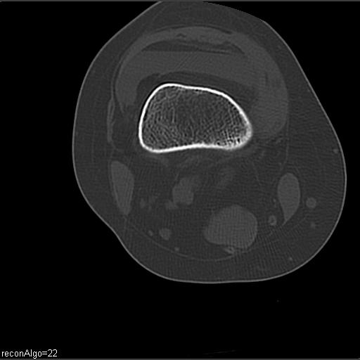 File:ACL avulsion fracture (Radiopaedia 33833-34994 Axial bone window 9).jpg