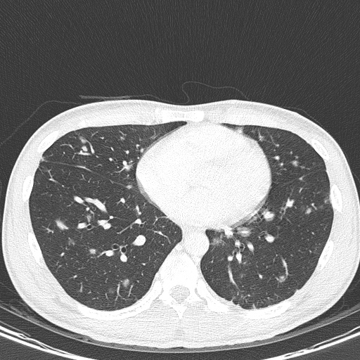 AIDS-related Kaposi sarcoma (Radiopaedia 85247-100811 Axial lung window 111).jpg