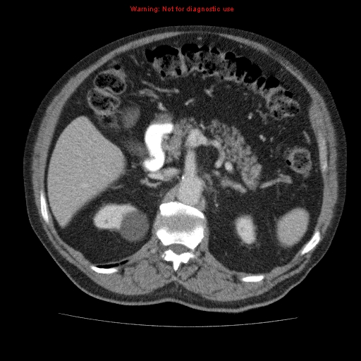 Abdominal aortic aneurysm (Radiopaedia 10122-10660 Axial C+ portal venous phase 24).jpg
