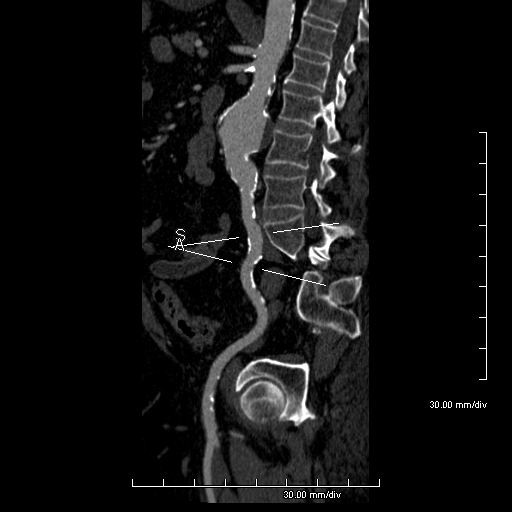 File:Abdominal aortic aneurysm (Radiopaedia 24449-24753 Curved parasagittal view C+ arterial phase 1).jpg