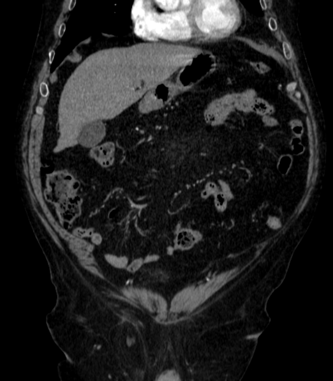 Abdominal aortic aneurysm (Radiopaedia 25855-26001 Coronal C+ arterial phase 4).jpg