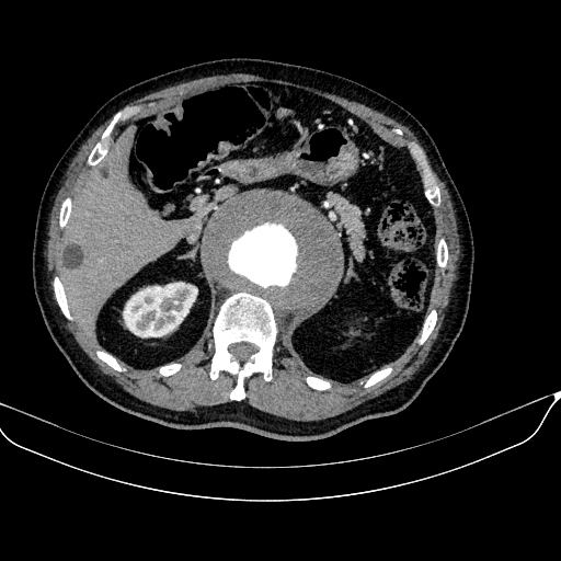 Abdominal aortic aneurysm (Radiopaedia 67117-76452 Axial C+ arterial phase 40).jpg