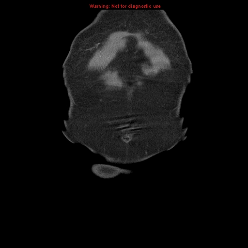 Abdominal aortic aneurysm (Radiopaedia 8190-9038 Coronal C+ arterial phase 3).jpg